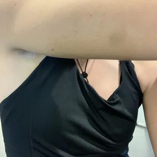 Bruises from bouncer Andrew who forcibly removed us for "not paying cover" -we were there with a group happy hour which waived our cover.