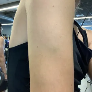 Bruises from bouncer Andrew who forcibly removed us for "not paying cover" -we were there with a group happy hour which waived our cover.