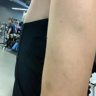 Bruises from bouncer Andrew who forcibly removed us for "not paying cover" -we were there with a group happy hour which waived our cover.