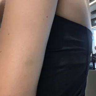 Bruises from bouncer Andrew who forcibly removed us for "not paying cover" -we were there with a group happy hour which waived our cover.