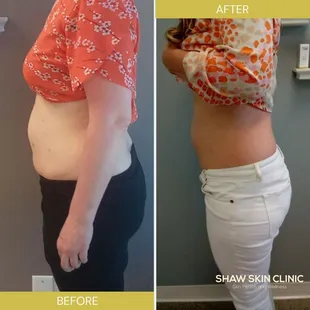 Body Contouring with Velashape
