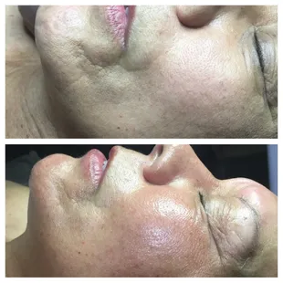 Try out our Ultimate Ultrasound Facial! Starting off with diamond tip microdermabrasion and ending treatment with rejuvenating ultrasound!