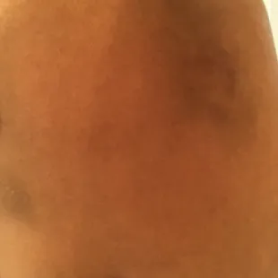My bruises after being physically assaulted by Pat the bartender there