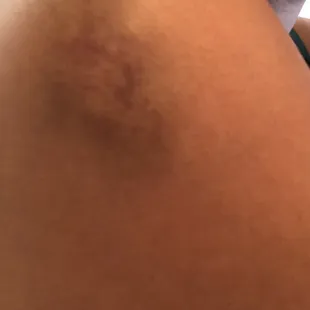 My bruises after being physically assaulted by Pat the bartender there