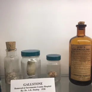 Gallstones!!