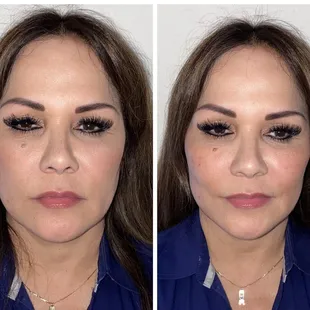 Before/after restylane Lyft