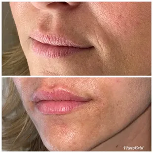 Before/after Restylane Kysse for lips