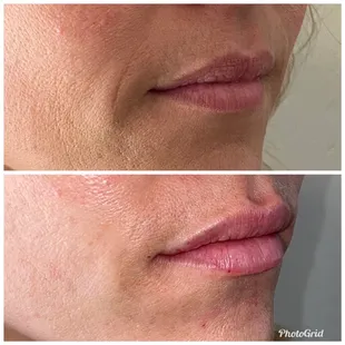 Before/after Restylane Kysse for lips