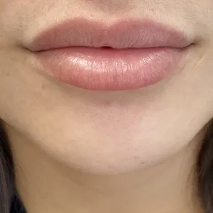 Juvederm Ultra