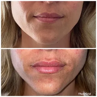 Before/after Restylane Kysse for lips