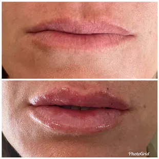Before/after Restylane Kysse for lips