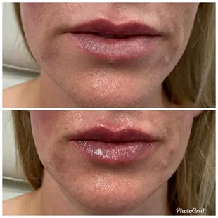 Juvederm Ultra