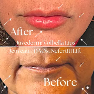 Enhance your natural beauty! We used  Juvederm for luscious, plump lips and Jeuveau to relax DAOs and sculpt a stunning Nefertiti lift.