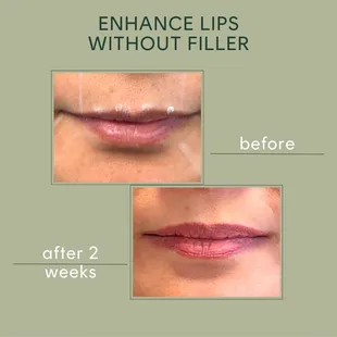 Fuller, natural-looking lips without filler! The Lip Flip enhances your pout by relaxing the muscles around the mouth with Xeomin or Jeuveau