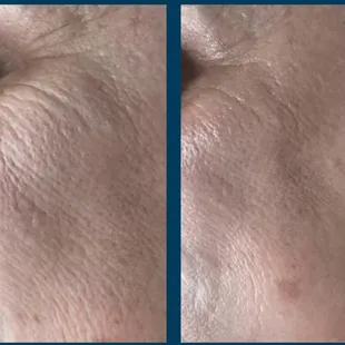 Real results, real confidence! This is a stunning transformation with SkinPen microneedling for fine lines, wrinkles, and uneven texture!