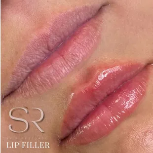 Lip Filler