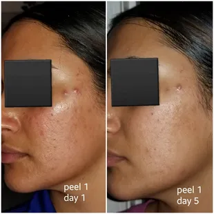 Day 1 &amp; Day 5 of Medium Peel