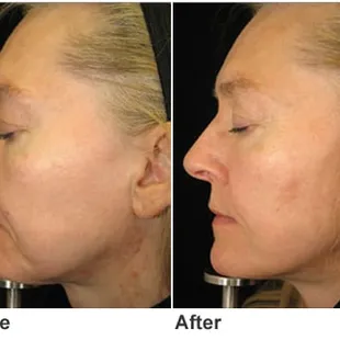 Fractional Non Ablative Skin Resurfacing for fine lines, wrinkles, melasma, scarring, while tightening too!
