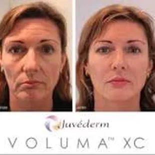Juvederm Voluma dermal filler lasts up to 2 years.