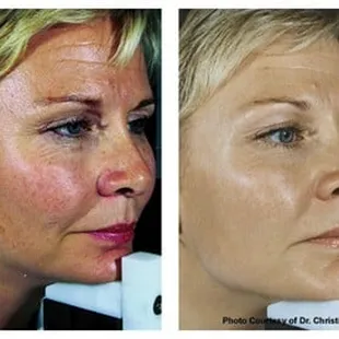 Photofacials for complexion correction of dark spots, broken vessels, and vascular melasma.  Photofacials by Beckie!