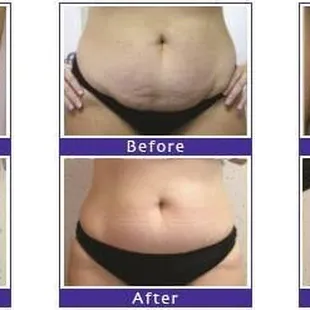 Viora RF CORE Technology for contouring, cellulite reduction and skin tightening