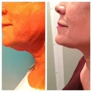 Viora Reaction Skin Tightening