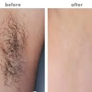 Permanent Laser Hair Reduction