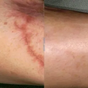 Fractional Skin Resurfacing for fine lines, wrinkles, scars, stretch marks and scars, while tightening too!