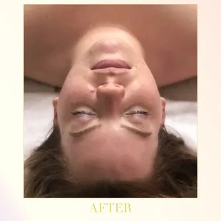 Facial After Shot - Scottsdale Arizona 2019
