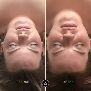 Before/After Shots of our clients Facial - Scottsdale Arizona 2019