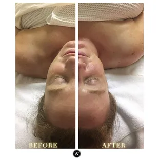 Before and After: Brightening Facial