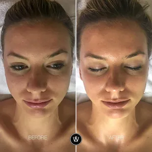 Before and After of Old Town Scottsdale favorite facial