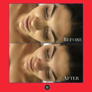 Before/After a Brightening Facial