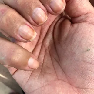 Nail damage post gel manicure. You can see the line from where they filed