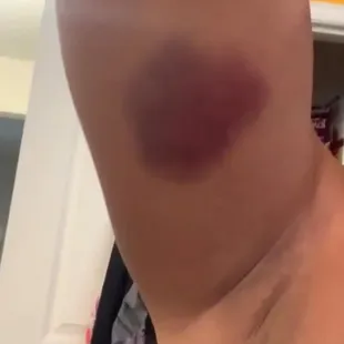 a woman&apos;s arm with a wound on it