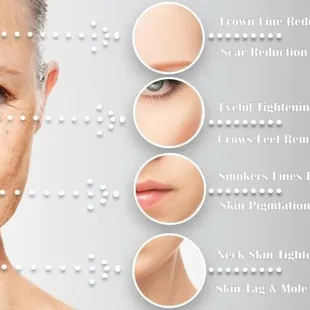 Fibroblasting Plasma Pen. Skin tightening for face and body, line removal, wrinkle reduction