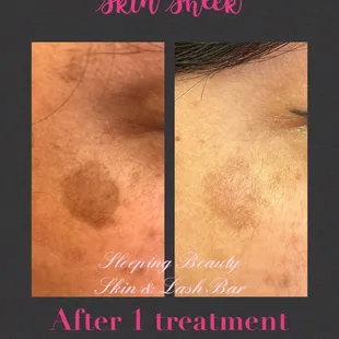 Skin Sheek- Sun damage removal.
