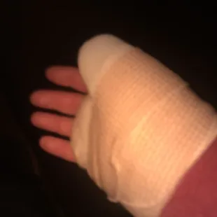 My broken hand.
