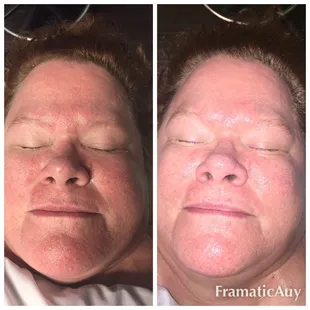 After 1 coolift session. Wrinkles reduced in minutes.