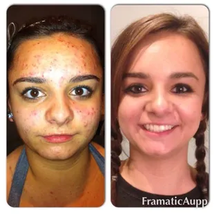 Before and after acne series of treatments. 5 PCA Peel treatments, 4 IPL Photofacials, 2  glycolic peels &amp; tons of extractions.