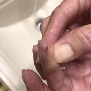 Finger cut with clippers