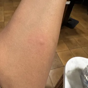 FRESH BED BUG BITE