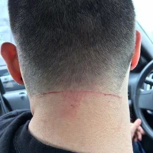 The aftermath of my boyfriend's haircut here. He had a painful, red hairline all day. This was the next day when it scabbed up. Not okay!