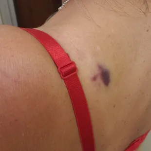 Left bruising &amp; blood blisters after each apt. I didn't have that with the bay area team.