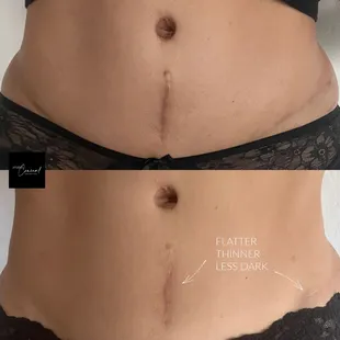 Surgical scar lightening on tummy tuck incision
