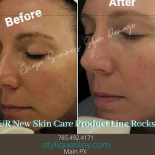 Chemical Peels available here