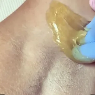 Underarm sugaring