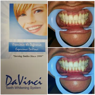 Laser Teeth Whitening, instant results