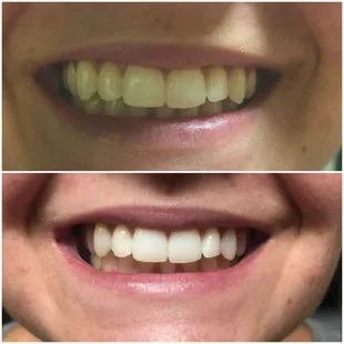 Laser Teeth Whitening