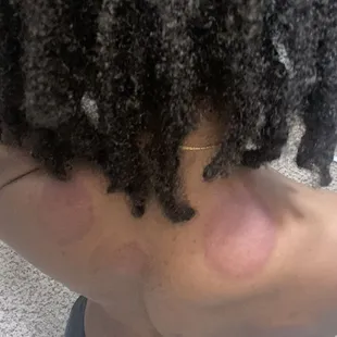 Few days after cupping.